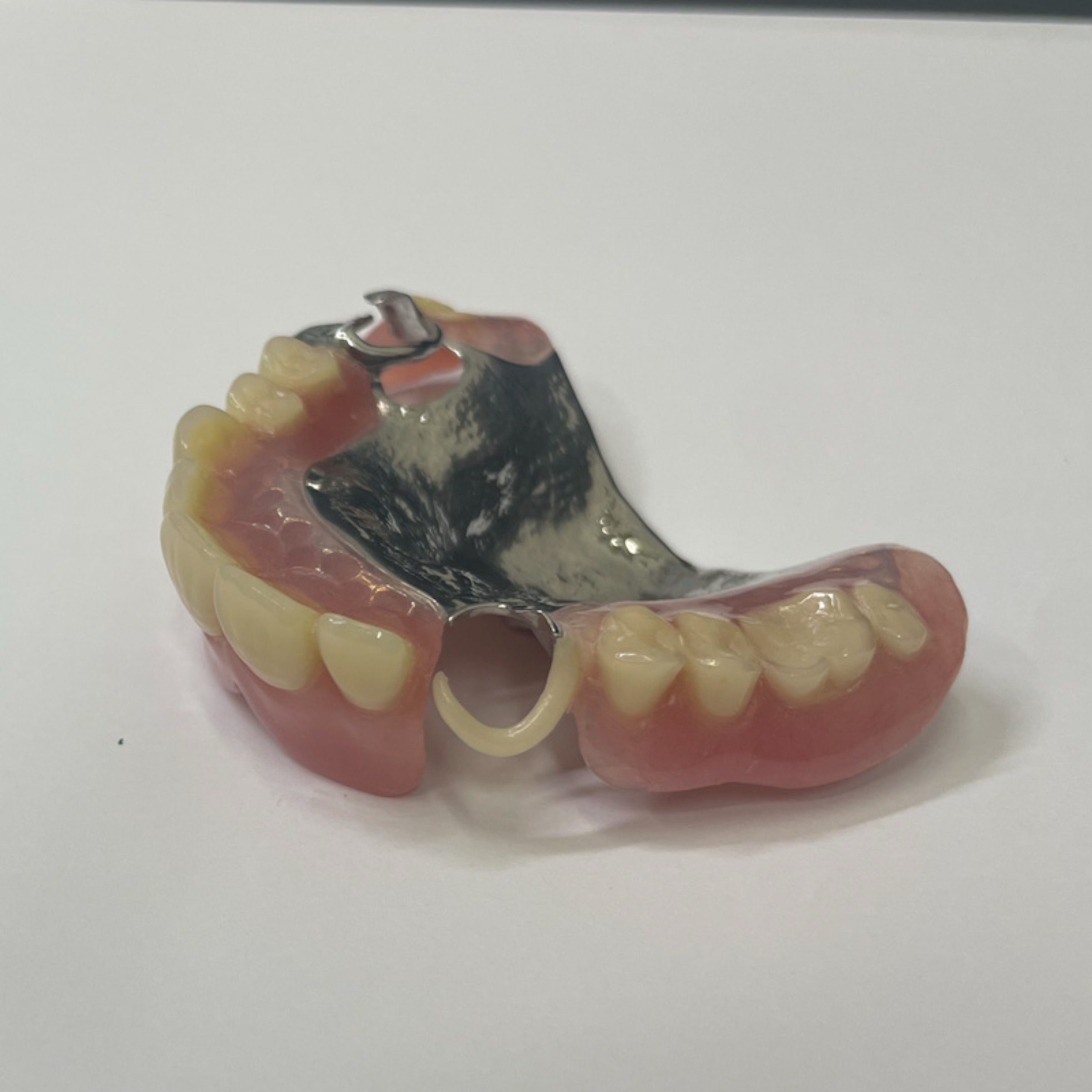 白い金具の義歯写真